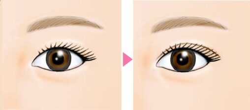 美容医療 施術イメージイラスト